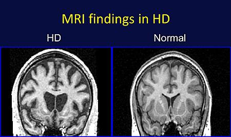 Huntington’s Disease Research Offers New Hope for Patients